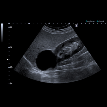 Echographie pelvienne et abdominale